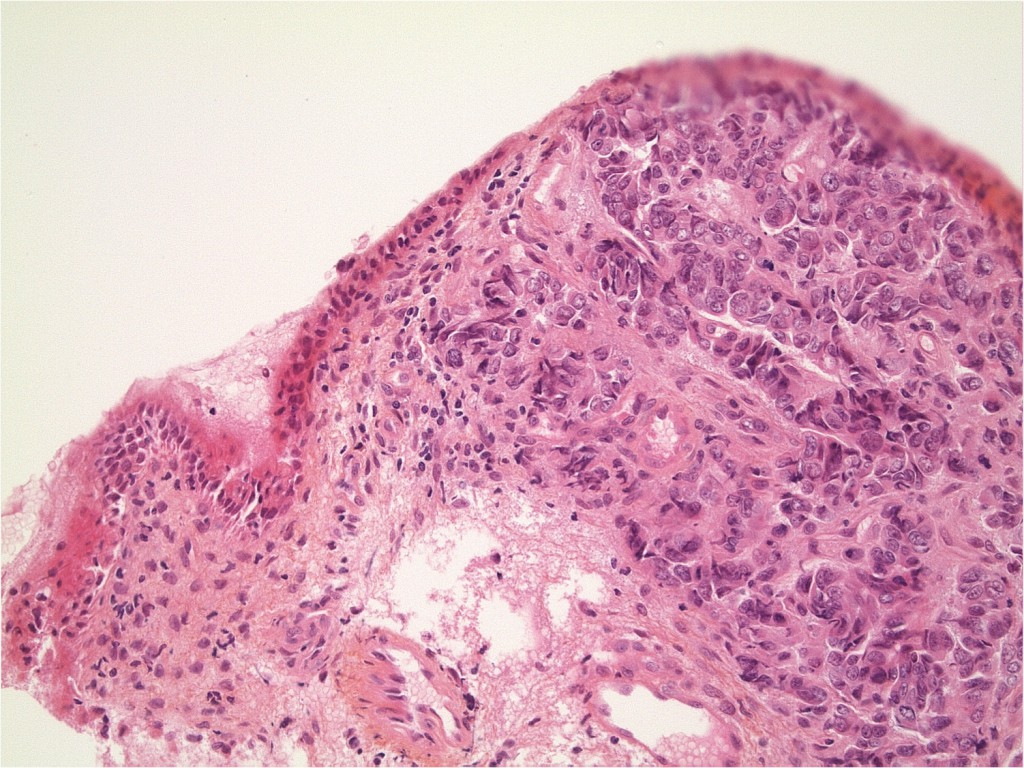 PrBernard-adenocarcinome