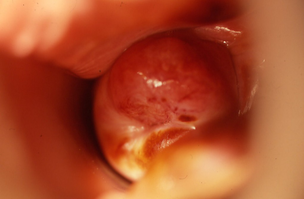 PrBernard-cancer-endocol